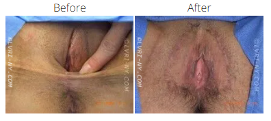 Before and after photos of vulva, showing surgical changes.