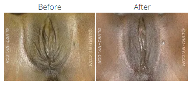 Comparison of before and after labia skin appearance, showing a color change.