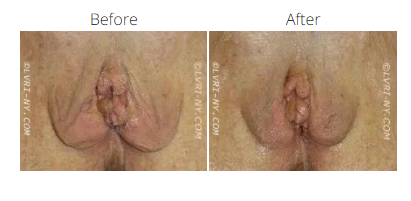 Before and after view of a perineum, showing a surgical procedure.