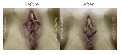 Before and after comparison of female genitalia, possibly after a medical procedure.