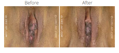 Comparison of before and after labiaplasty. The after image shows a reduction in size.