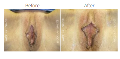 Comparison of before and after labiaplasty. The