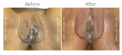 Comparison of vulva, before and after a procedure.