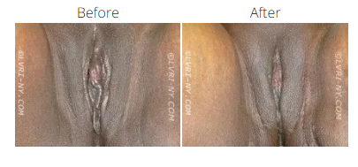 Comparison of a vulva before and after a procedure.