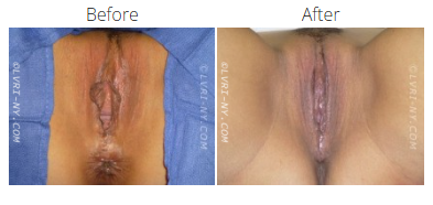Comparison of female genitalia before and after surgery.