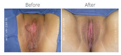 Before and after photos of vulva, showing a change in appearance after a procedure.