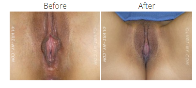 Comparison of vulva: before and after labiaplasty surgery.