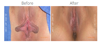 Comparison of a vulva before and after a procedure. The