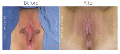 Comparison of a labiaplasty before and after. Before image shows enlarged labia. After image shows smaller labia.
