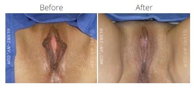 Comparison of vulva before and after surgery.