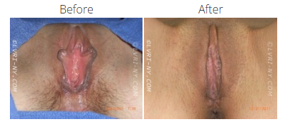 Before-and-after photos of a vulva, showing a surgical procedure. The
