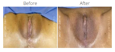 Comparison of a vulva before and after a procedure, showing skin tone change and anatomical details.