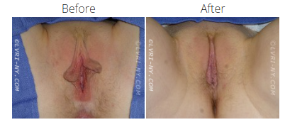 Comparison of a labiaplasty before and after surgery.
