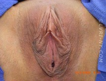 Close-up view of female genitalia; outer labia with dark pigmentation, folds, and a visible clitoris.