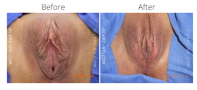 Comparison of vulva, before and after a procedure. Skin tone varies with lighting.