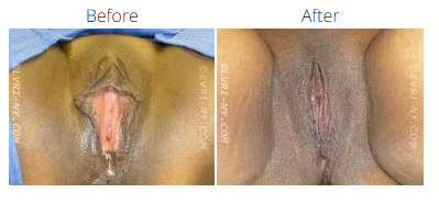 Comparison of a vulva before and after a surgical procedure.