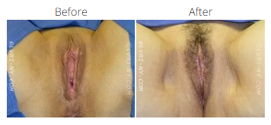 Comparison of female genitalia before and after a procedure.