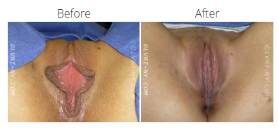 Before and after comparison of a vulva, showing labiaplasty results.