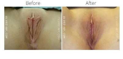 Before and after images of a vulva, showing a change in size and shape.