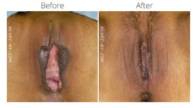 Comparison of a vulva before and after a surgical procedure. Before has more prominent labia; after, labia are reduced.