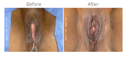 Before and after comparison of female genitalia, likely showing labiaplasty results.