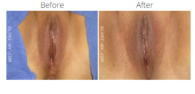 Comparison of a vulva before and after a surgical procedure.