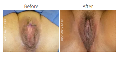 Before and after view of a vulva. Before image shows dark discoloration. After image shows lighter color.
