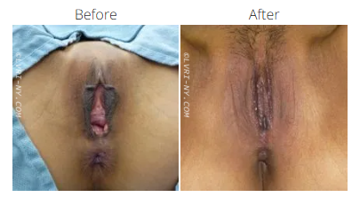 Comparison of vulva before and after surgery.