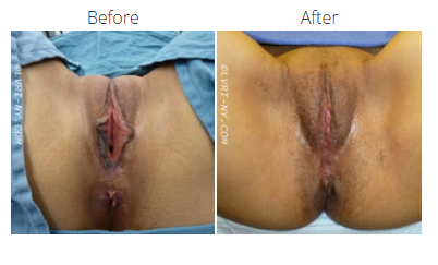 Comparison of vulva: Before shows dark discoloration; After shows lighter, even tone.