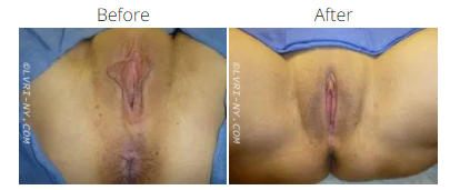 Before and after photos of a vulva, possibly showing a cosmetic procedure.