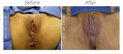 Before and after photos of a vulva. The