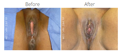 Comparison of a vulva before and after a procedure, showing changes in color and appearance.
