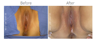 Before and after photos of a vulva, showing a surgical procedure. The