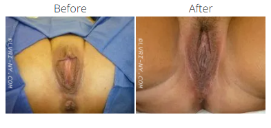 Before and after photo of a vulva. The 'before' shot shows a more full appearance. The 'after' shot shows a more sculpted look.