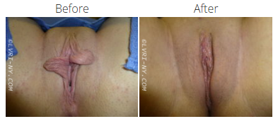 Comparison of a vulva before and after labiaplasty surgery.