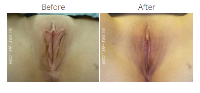 Comparison of a vulva before and after a procedure, showing changes in appearance.