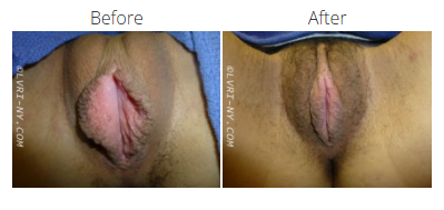 Comparison of a vulva before and after a medical procedure.
