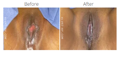 Comparison of labia,