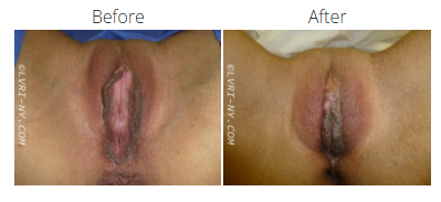 Comparison of vulva before and after a procedure.