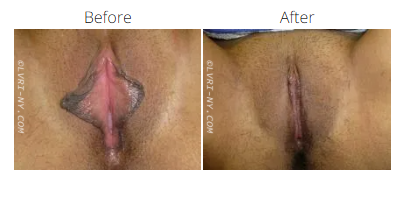 Comparison of a vulva before and after a procedure. The labia minora are reshaped, skin tone improved.