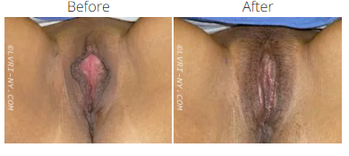 Before and after comparison of female genitalia, showing changes after a procedure.