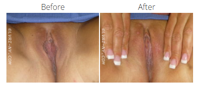 Before and after images of a vulva. The