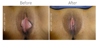 Comparison of vulva before and after labiaplasty.