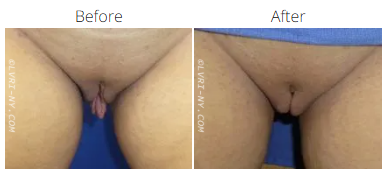 Comparison of a vulva before and after a procedure.