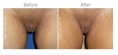 Comparison of before and after labiaplasty. The