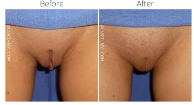 A close-up of a woman's pubic area, before and after a labiaplasty procedure.