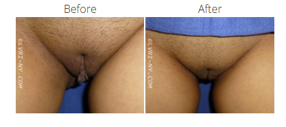 Comparison of a person's genital area before and after a procedure. The