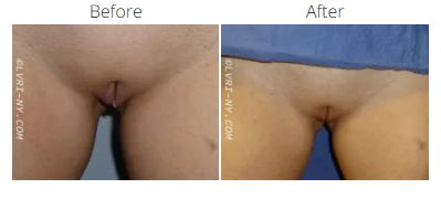 Comparison of before and after labiaplasty photos. Close-up of female genitalia. Skin tone is light brown.