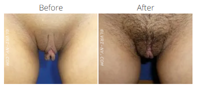 A before-and-after comparison of a vulva, showing a change in appearance and hair.