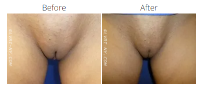 Comparison of a vulva before and after a procedure. The after image shows less hair.